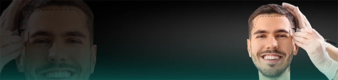 Hair Transplant in Turkey