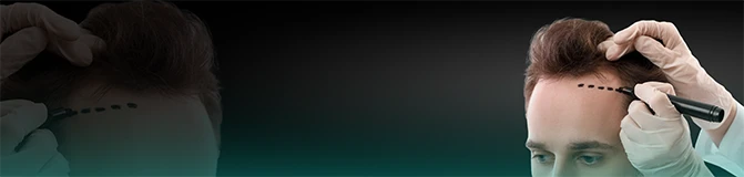Sapphire FUE Hair Transplant