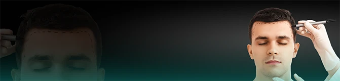 Organic Hair Transplantation