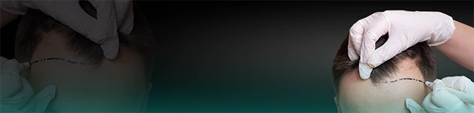 FUE Hair Transplantation