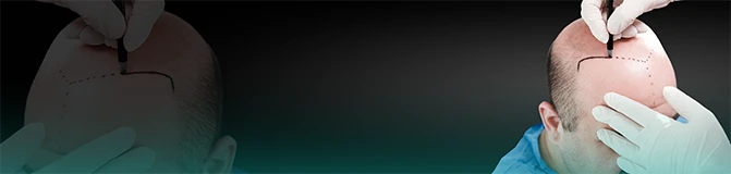 DHI Hair Transplantation