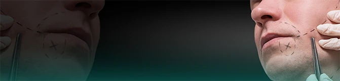 Beard Transplantation