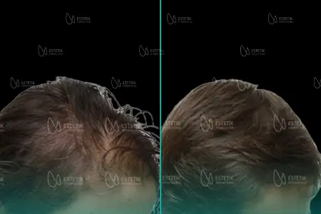 Before-After Combined