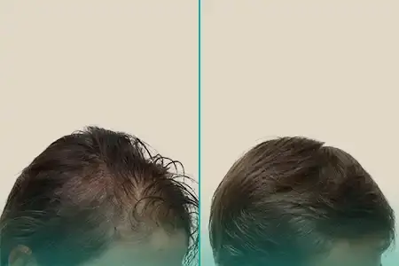 Before-After Combined