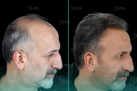 Before-After Combined