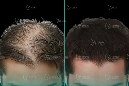 Before-After Combined