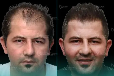 Before-After Combined