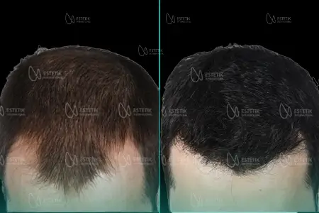 Before-After Combined