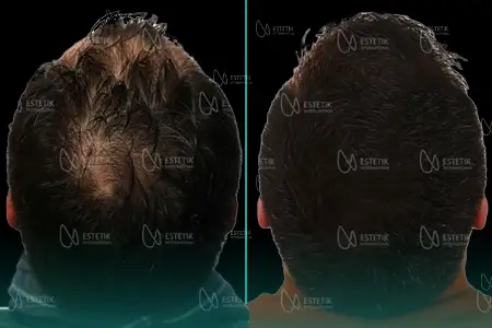 Before-After Combined