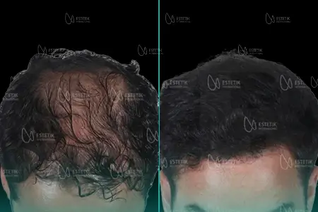 Before-After Combined