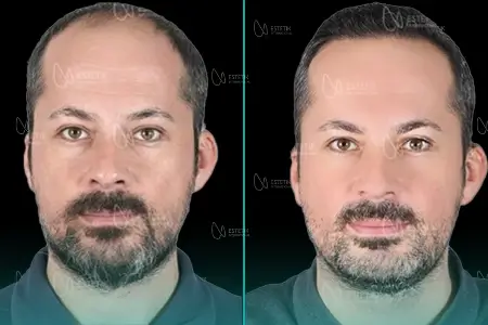 Before-After Combined