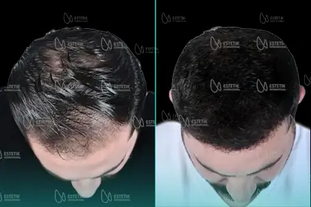 Before-After Combined