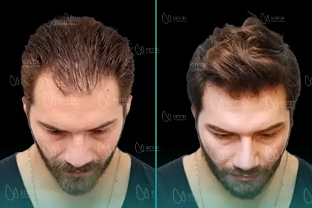 Before-After Combined