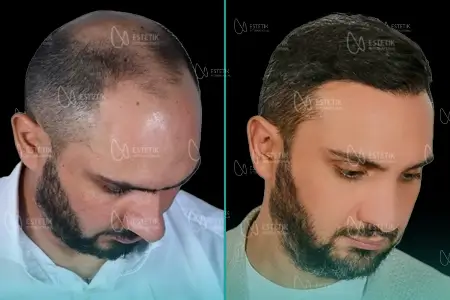 Before-After Combined