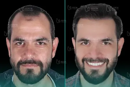 Before-After Combined