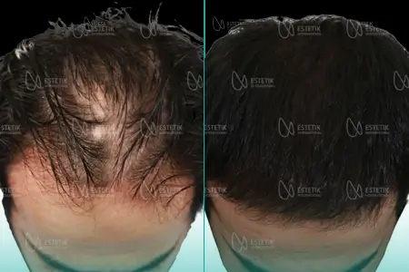 Before-After Combined