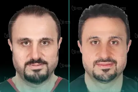 Before-After Combined