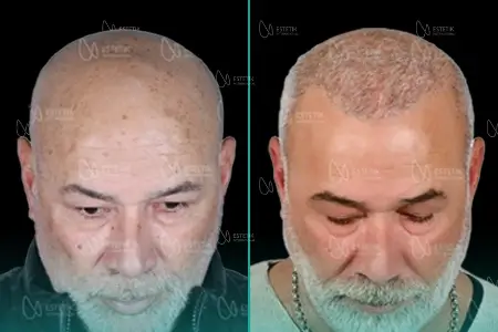 Before-After Combined