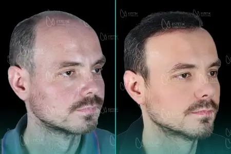 Before-After Combined