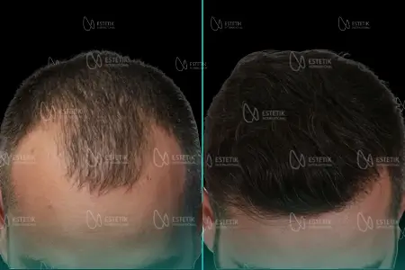 Before-After Combined