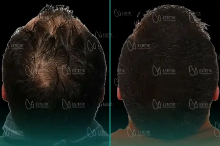 Before-After Combined