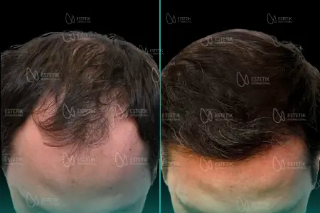 Before-After Combined