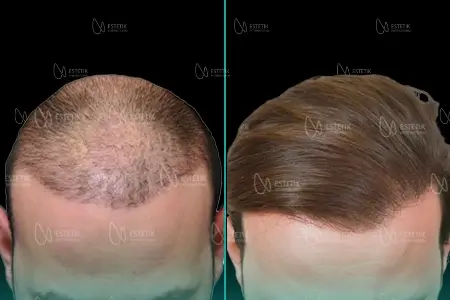 Before-After Combined